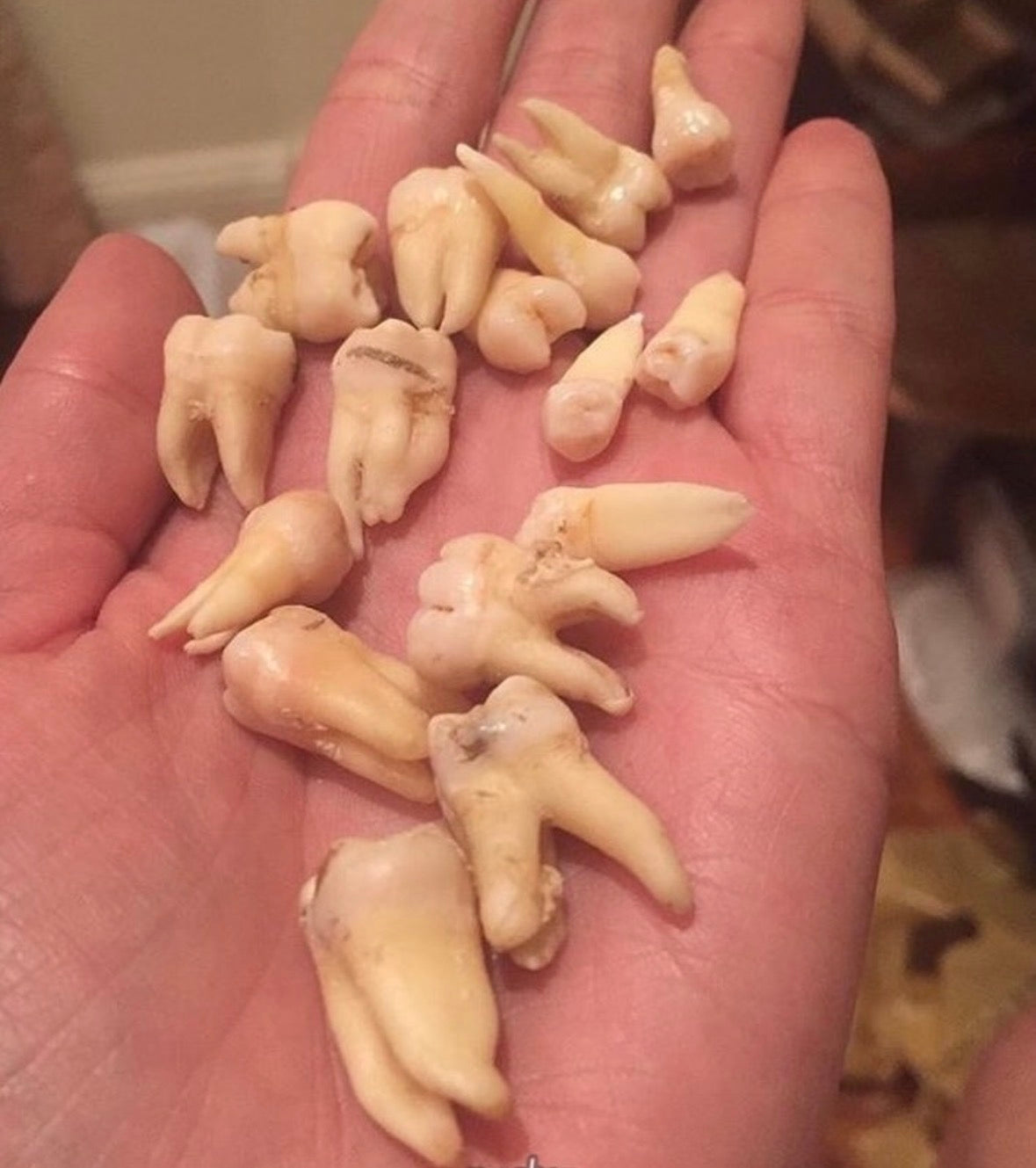 Individual Molars